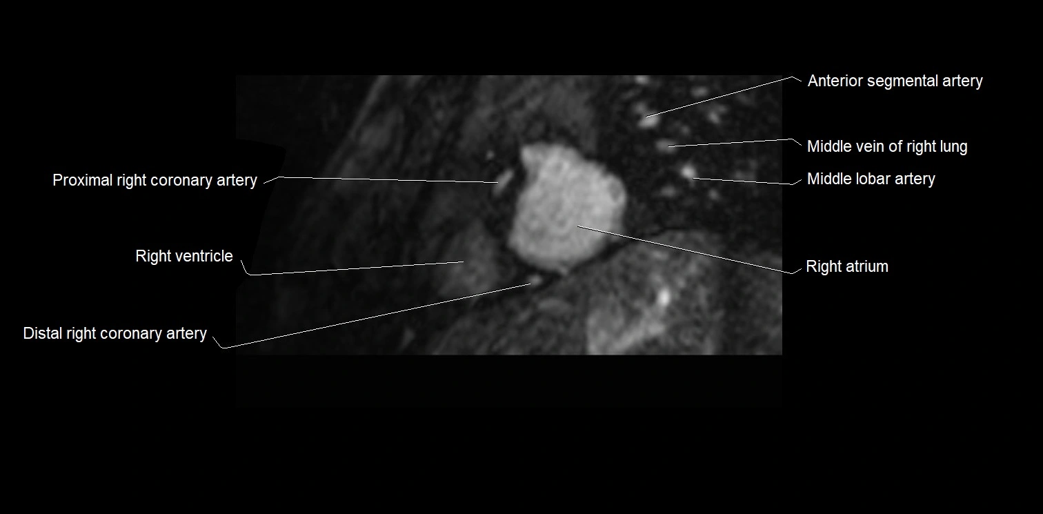 MRI heart and coronary arteries two chamber(sagittal)  anatomy image 5.webp